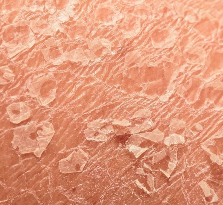 ¿Cómo saber si tu piel está deshidratada?