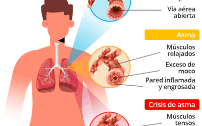 ¿Podés operarte si tenés asma o hipertensión? La respuesta médica y todo lo que necesitás saber