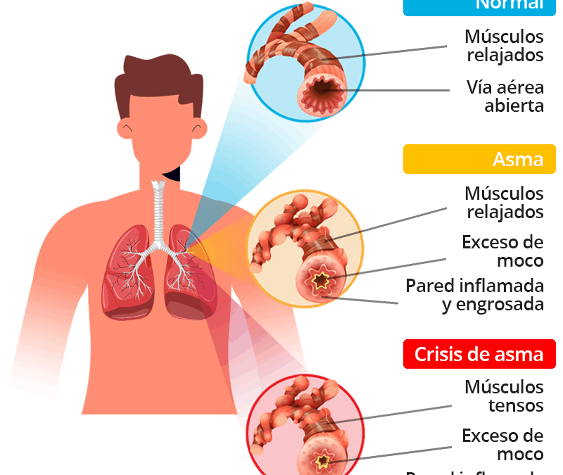 ¿Podés operarte si tenés asma o hipertensión? La respuesta médica y todo lo que necesitás saber